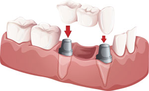 Example of dental implants in Mercer Island WA